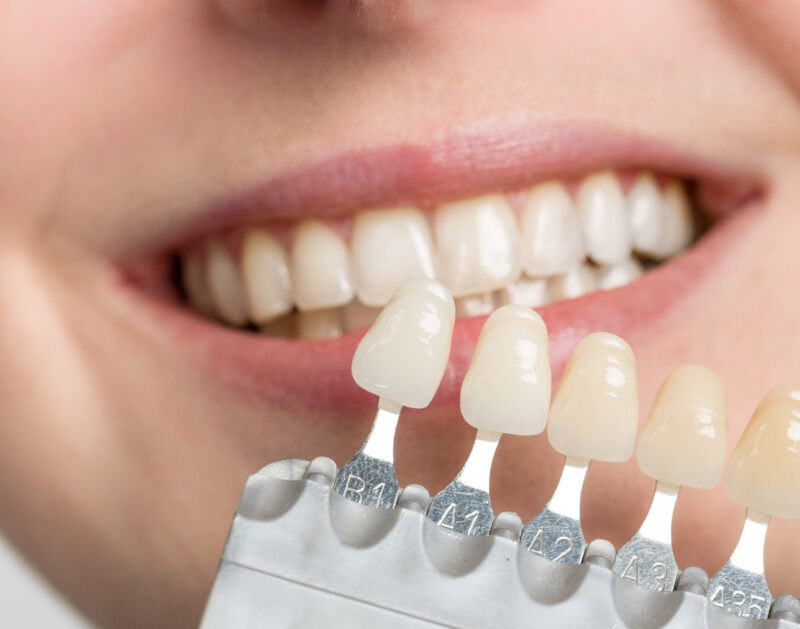 Blog -Bridge Dental