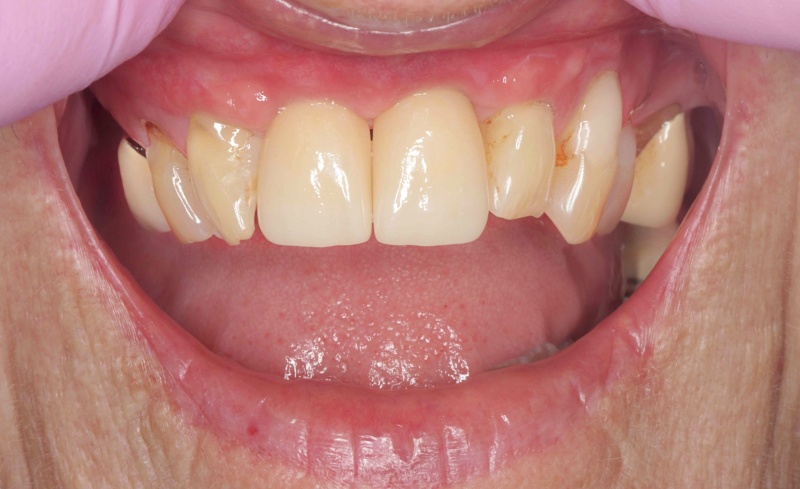 After -Bridge Dental