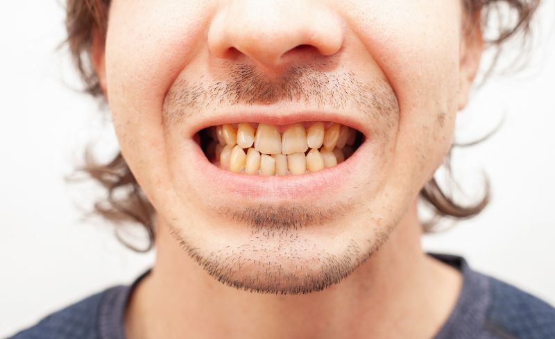 Before - Bridge Dental