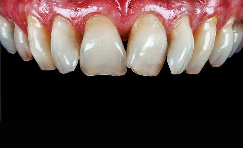 Before - Bridge Dental